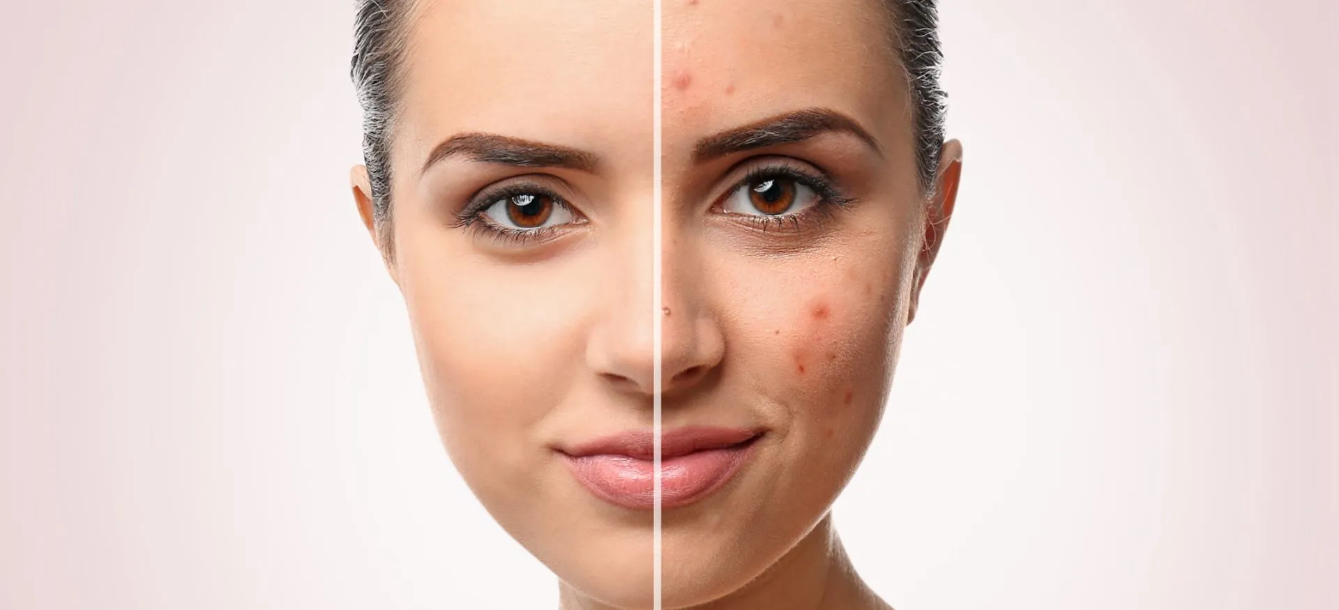 Acne Treatment