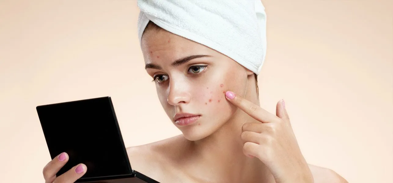 Acne Treatment