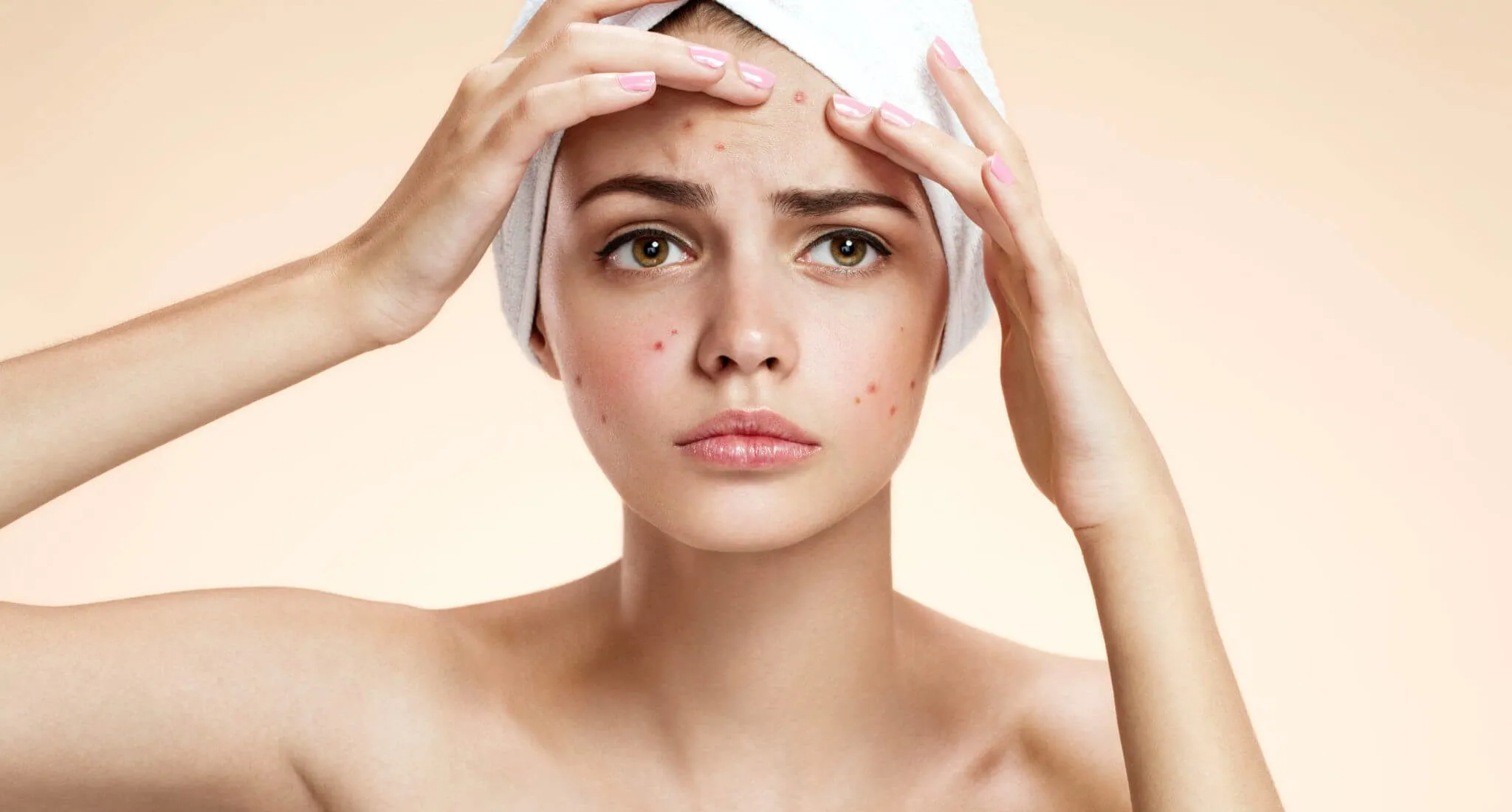 Acne Treatment
